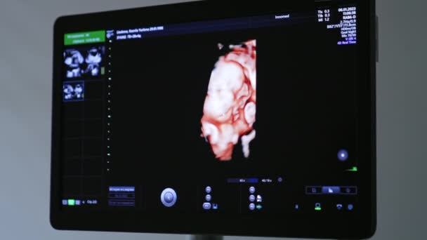 Ultraschallbild Des Ungeborenen Babys Auf Dem Schwarzen Bildschirm Der Geräte — Stockvideo