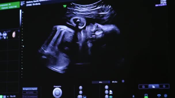 Watching Unborn Baby Move Mom Abdomen Child Image Screen Ultrasound — Stock Video