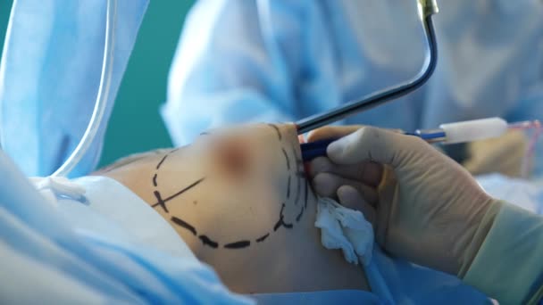 Ręka Chirurga Rękawiczki Trzymać Przyrząd Stosowany Obszarze Piersi Pacjenta Chirurgia — Wideo stockowe
