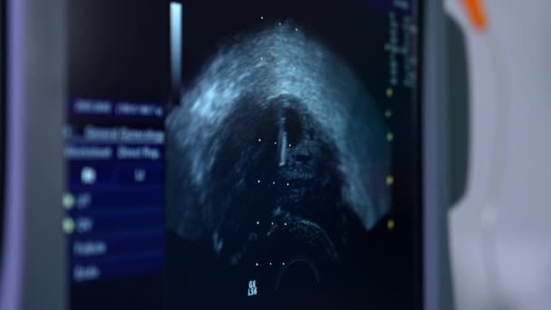 Imagine Ultrasunete Ecranul Ultrasunete Aproape Verificarea Abdomenului Înainte Procedura Fiv — Videoclip de stoc
