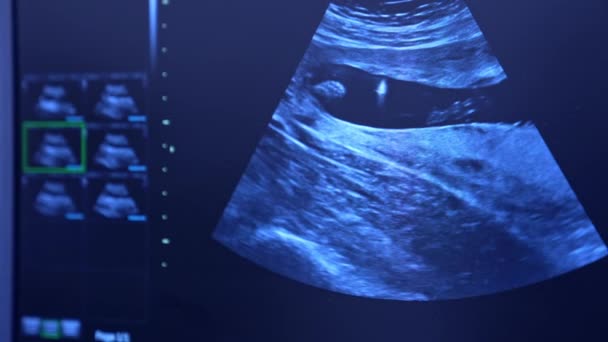 Screen Ultrazvukového Zařízení Zobrazující Proces Umělého Mimotělního Oplodnění Moderní Nemocnici — Stock video