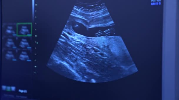 Εικόνα Υπερήχων Εξωσωματικής Γονιμοποίησης Κλείσε Σύγχρονος Νοσοκομειακός Εξοπλισμός Για Την — Αρχείο Βίντεο