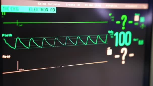 Laufkurve Der Herzfrequenz Des Patienten Während Der Operation Arbeitsgeräte Operationssaal — Stockvideo