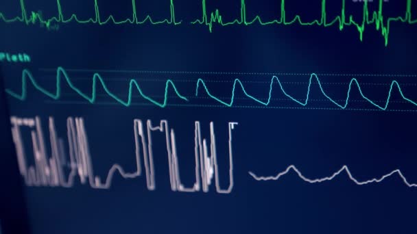 Três Curvas Diversas Correndo Tela Equipamento Sinais Vida Paciente Momento — Vídeo de Stock