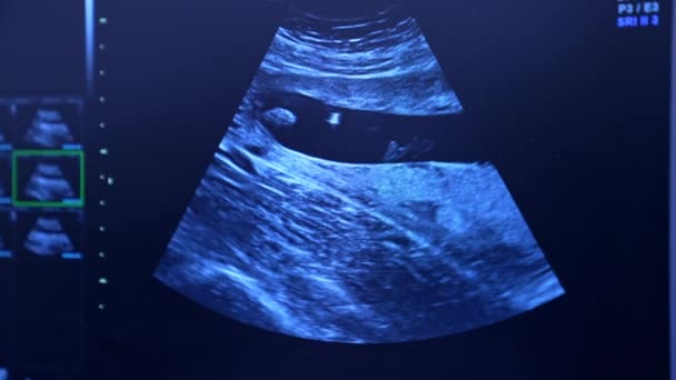 Ultrasonic Image Female Reproductive Organs Diagnostics Patient Extracorporeal Insemination Close — Stock Video