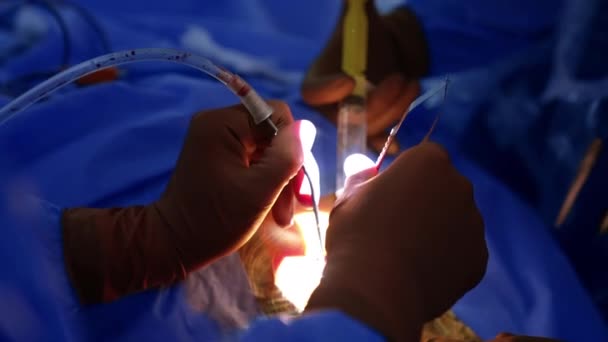 外科医生的手戴着乳胶消毒手套 在工作中使用工具 医生的头灯突出了手术区域 靠近点 — 图库视频影像