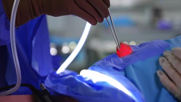 Instrumente Werden Von Behandschuhten Händen Des Chirurgen Die Nasenhöhle Eingeführt — Stockvideo