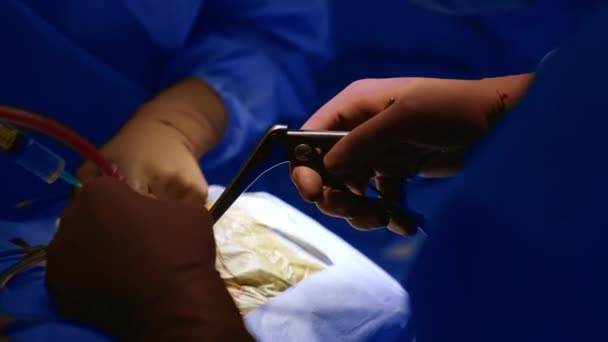 Ruce Chirurga Hnědých Latexových Rukavicích Používají Při Operaci Kovové Nástroje — Stock video