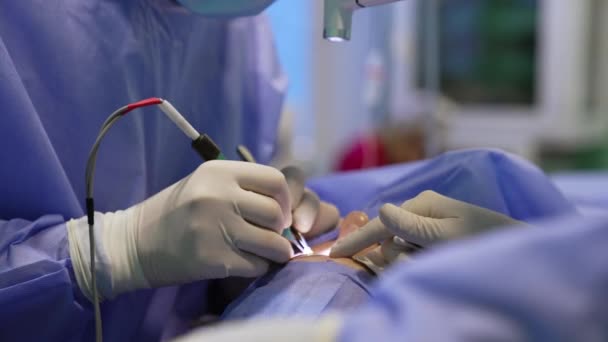 Las Manos Enguantadas Los Cirujanos Cumplen Operación Blefaroplástica Médico Jefe — Vídeo de stock