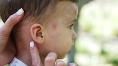 Anne, bebeğinin başını tutuyor. Bakıcı anne sivrisinek ısırığından kalan lekelerin üzerine biraz merhem sürer. Kapat..