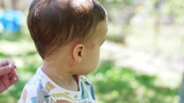 Dışarıda güzel bir erkek bebek var. Sivrisinek ısırığından dolayı kırmızı lekeleri olan bir çocuk ve annesinin eli merhem sürüyor. Kapat..