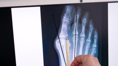 Valgus deformasyonu olan bir ayağın röntgeni. Doktorun eli, kalemin doğru ayak parmağı pozisyonunu gösterdiğini gösteriyor. Kapat..