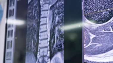 Bir hastanın MRI teşhisi. Omurga ve vücudun diğer bölümleri ekranda..