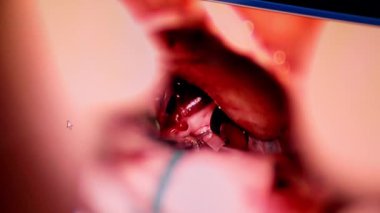 Metal aletler cerrahi operasyonlarda kullanılır. Ekranda mikro cerrahi operasyon odasında görünüyor. Kapat..