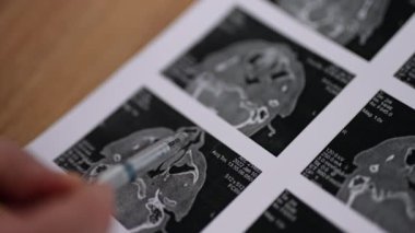 Tanımlanamayan doktor, hastanın MRI taramasında burun boşluğu sorunlarını gösteriyor. Kapatın. Otolaryngology konsepti.