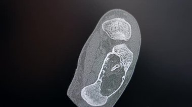 Siyah ekrandaki vücut parçasının MRI taramasına daha yakından bakın. Hastanedeki ameliyata hazırlık. Kapat..