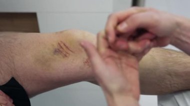 Doktorun eli, hastanın bacağında morluklar var. Cerrah, gelecekteki travma geçirmiş diz ameliyatını açıklıyor. Kapat..