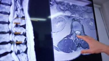 Erkek doktorun eli bir hastanın MRI taramasına bakıyor. Cerrah, beyin cerrahisinden önce sorunu tanımlar..
