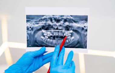 Klinikteki diş röntgeninin yakın çekimi. Eldivendeki bir diş hekimi, modern bir klinikte kırmızı noktalı belirli bölgelere odaklanan bir diş röntgenini inceliyor..