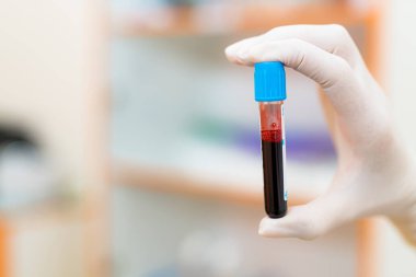 Test tüpünde kan örneğiyle birlikte. Eldiven giyen bir kişi, analiz için laboratuvar ortamında kan örneği içeren bir test tüpü tutuyor..