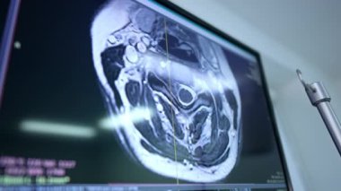 İnsan beyninin MR taramasıyla geniş ekran. Hastanın kafatası üst görünümünü gösteren monitörde düşük açı görünümü.