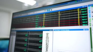 Modern bilgisayar ekipmanları ameliyathanede. Monitördeki beyin dalgaları. Kapat..