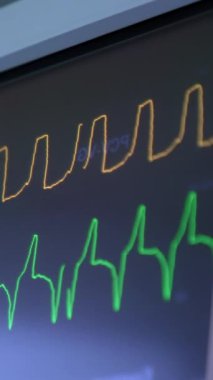 Tıbbi ekipmanların siyah ekranında yeşil ve turuncu kıvrımlar var. Kapatın. Yaşam sinyalleri hastayı ameliyata alıyor. Dikey video