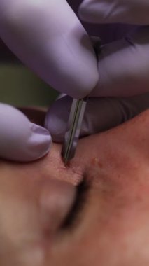 Güzellik uzmanı bir müşterinin gözeneklerini açmak için keskin aletler kullanır. O zaman siyah başlık kaldırma uygulanır. Aşırı yakın çekim. Dikey video