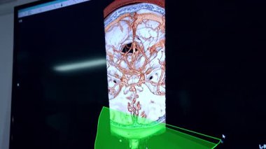 Tıbbi ekipmanların monitöründe aort diseksiyonu taraması. Kapatın. Nörolojik işlem hazırlığı.