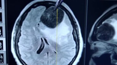 Kafasının MRI taramasıyla ekranı işaret eden bir kalem. Beyin ameliyatından önce tümörü teşhis edememişler. Kapat..