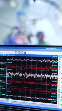 Nöroşirürji altındaki hastanın beyin çalışması monitördeki grafiklerde gösterildi. Kapatın. Mikrocerrahi devam ediyor. Dikey video.