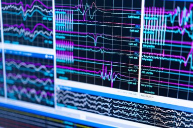 EEG beyin dalgası analizi. Bir EEG oturumu sırasında kaydedilen elektriksel aktiviteyi gösteren birden fazla beyin dalgası deseni ekranlarda görüntülenir.