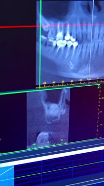 Dişleri olan ağız boşluğunun röntgeni. Diş tanısı için dijital ortomografiyi kapatın. Dikey video
