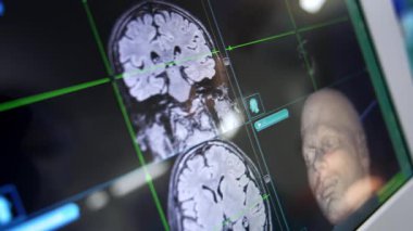 Hastanın beyninin 3 boyutlu görüntüsü. MRI tarama görüntüleri üzerinde çalışıyoruz. Kapatın. Nöroşirürji konsepti.