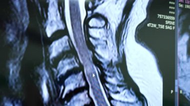 Işık ekranındaki hastanın MRI taraması. Kapatın. Sorunlu bölgede beyaz daraltma.