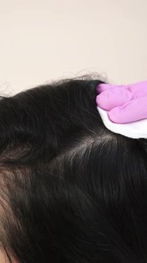 İğne mezoterapisi. Kadının kafasına kozmetik enjekte edilmiş. Kılları güçlendirmek ve büyümelerini dikey görüntülemek için itme