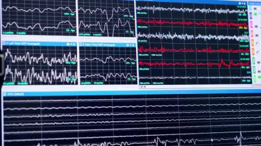 Çeşitli bölümlere ayrılmış bir bilgisayar ekranı. Ekranda kıvrımlı çizgiler kayıyor. Kapatın. Beyin ameliyatı..