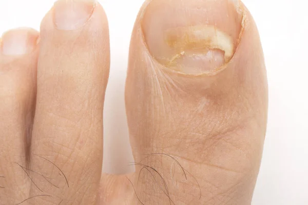 Toe nail fungus that has affected the big toe of a man.
