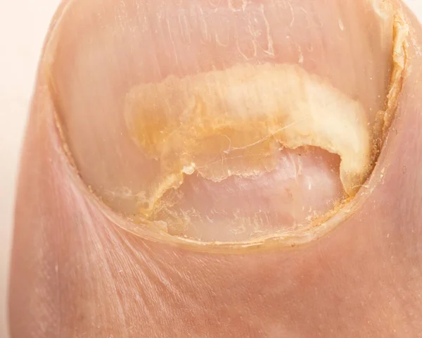Грибок Ногтей Который Повлиял Большой Палец Ноги Человека — стоковое фото