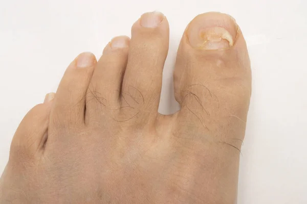 Toe nail fungus that has affected the big toe of a man.