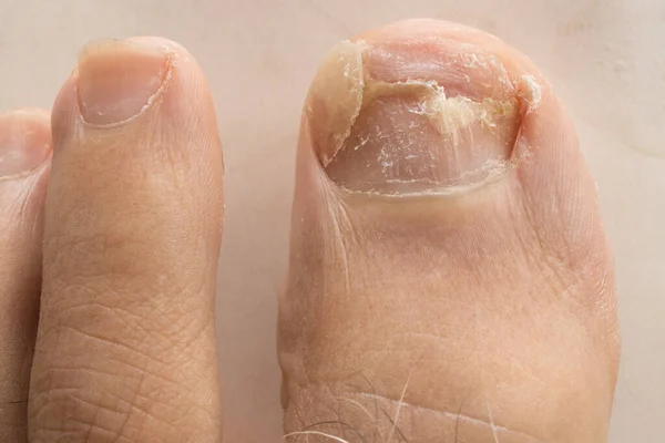 Toe nail fungus on a big toe causing the nail to fall off