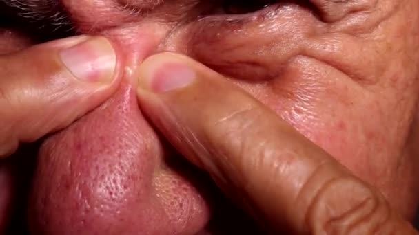Man Trying Pop Pimple Bridge His Nose — Videoclip de stoc