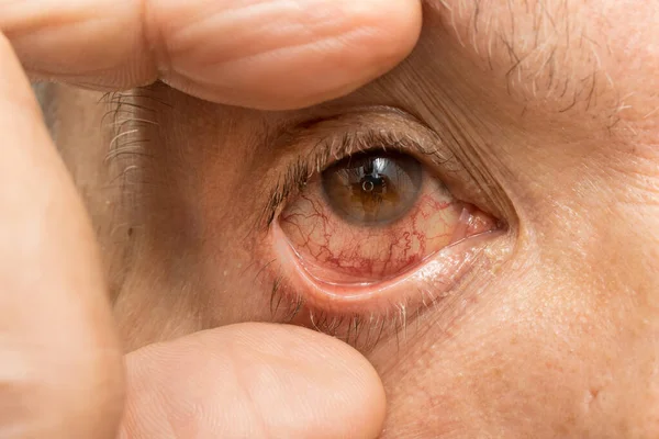 stock image Senior Man with a pink eye infection in one of his eyes