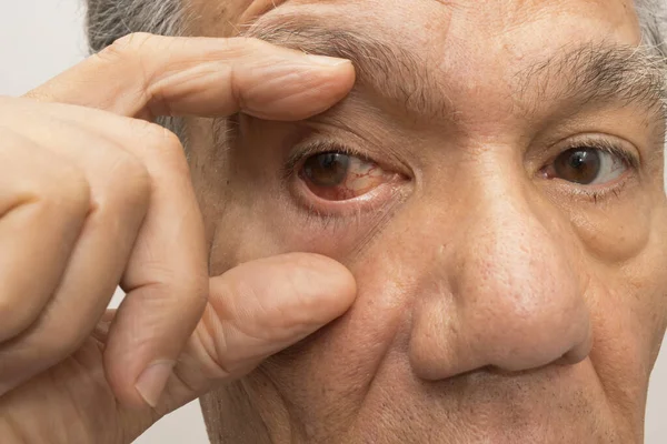 Hombre Mayor Con Una Infección Ocular Rosa Uno Sus Ojos — Foto de Stock