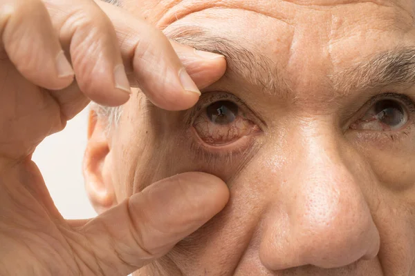 Hombre Mayor Con Una Infección Ocular Rosa Uno Sus Ojos — Foto de Stock
