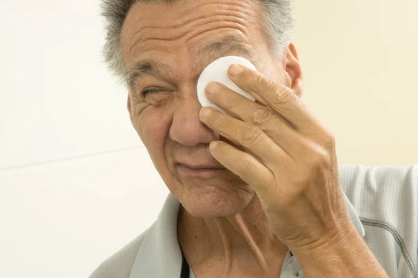 Hombre Mayor Baño Usando Almohadillas Algodón Para Alivio Ocular — Foto de Stock