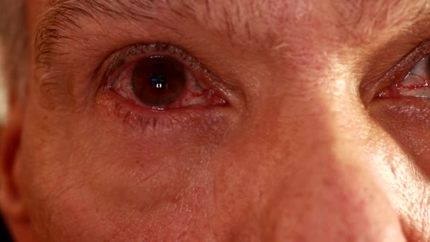 シニア男とともにピンクの目の感染症で彼の目の一つ — ストック動画