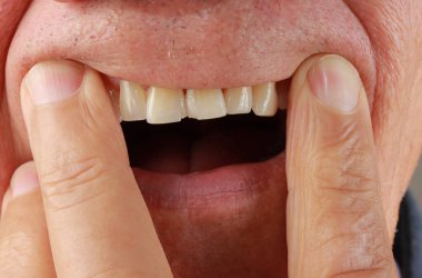 Adam iki ön dişinin kırıldığını gösteriyor.