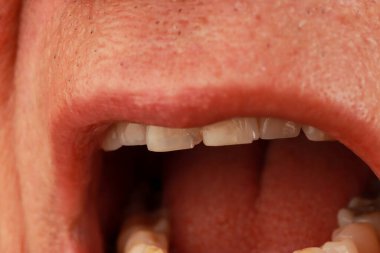 Adam iki ön dişindeki küçük çipleri gösteriyor.