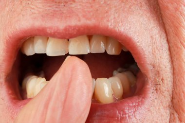 Adam iki ön dişindeki küçük çipleri gösteriyor.
